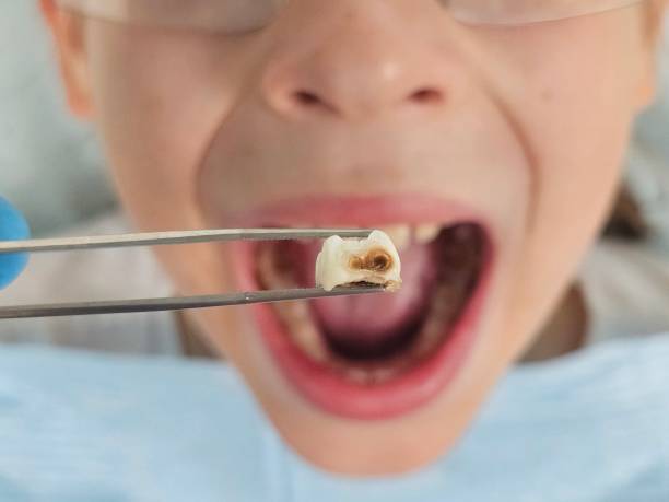 Best Knocked-Out Tooth (Avulsed Tooth) Treatment in Sumner, IA